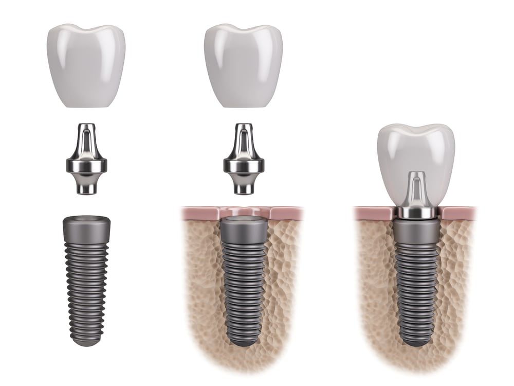 Dental Implants Johns Creek