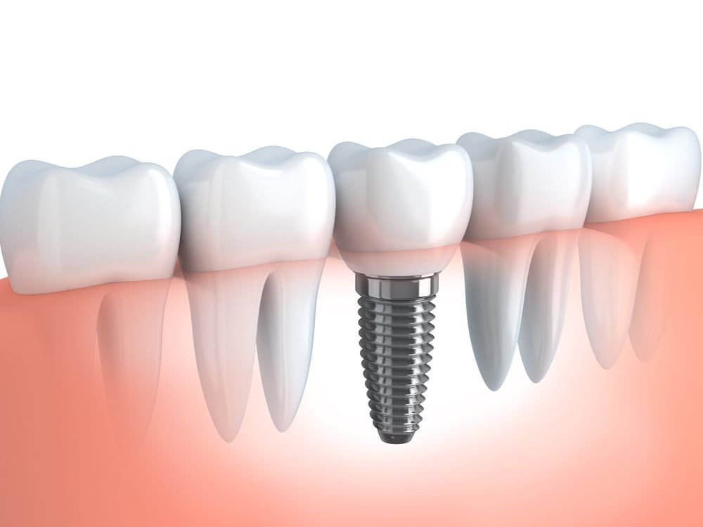 Dental Implants in Johns Creek