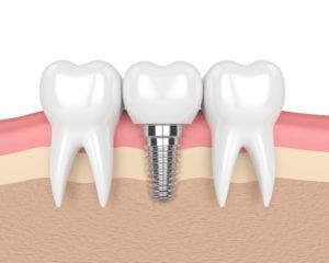 Dental Implants Johns creek